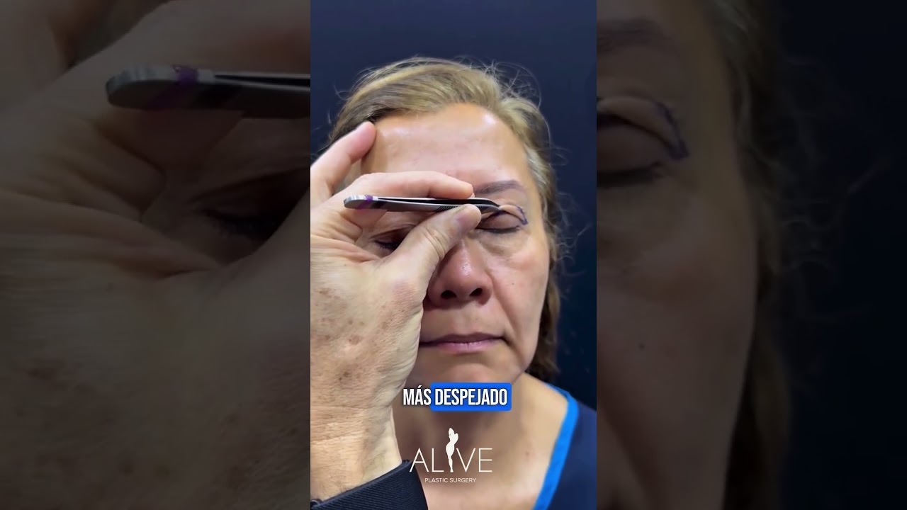 🌟Pinch Blepharoplasty - Part 1🌟