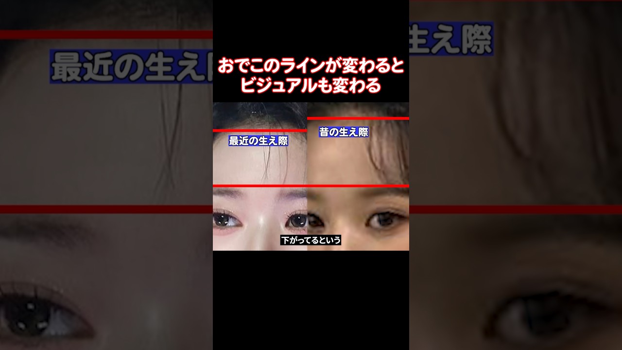 おでこのラインを矯正してビジュアルが変わったアイドルたち