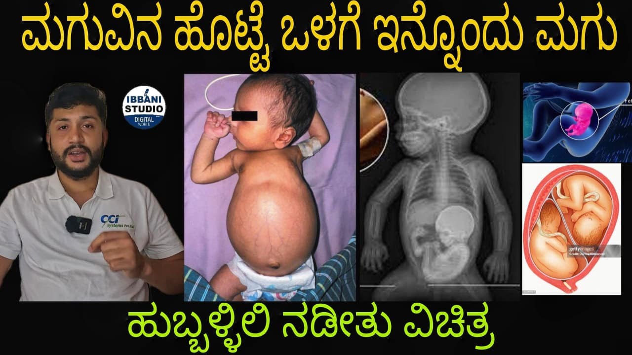 ಮಗುವಿನ ಹೊಟ್ಟೆ ಒಳಗೆ ಇನ್ನೊಂದ್ ಮಗು | ಮಗು ನೋಡಿ ವೈದ್ಯರೇ ಗಾಬರಿ | Fetus in Fetu | Hubballi Baby