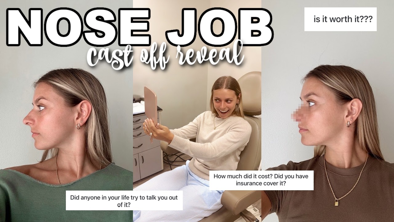NOSE JOB VLOG PART 2: cast off reveal, splint removal, new nose Q&A