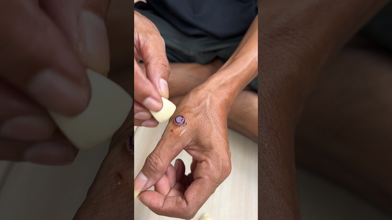 CARA MUDAH MENGHILANGKAN KUTIL #trending #shortvideo #diy #viral #obat #shorts #KaryaJangyaya