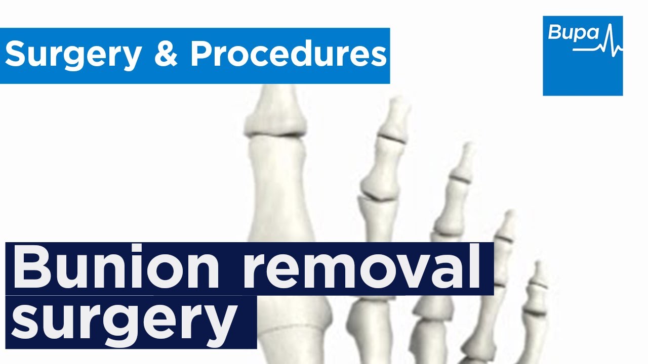How bunion removal surgery is carried out | Bupa Health