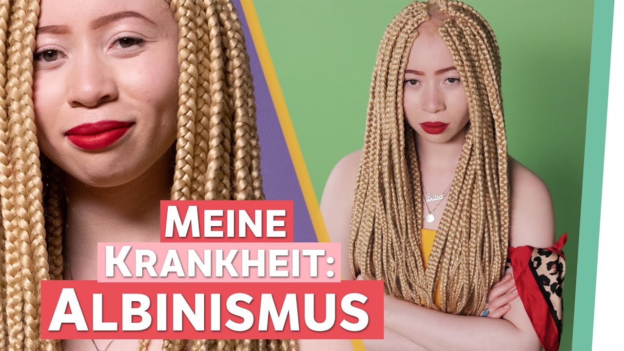 Albinismus &ndash; Ich bin eine Schwarze Frau mit Wei&szlig;er Haut. | Auf Klo
