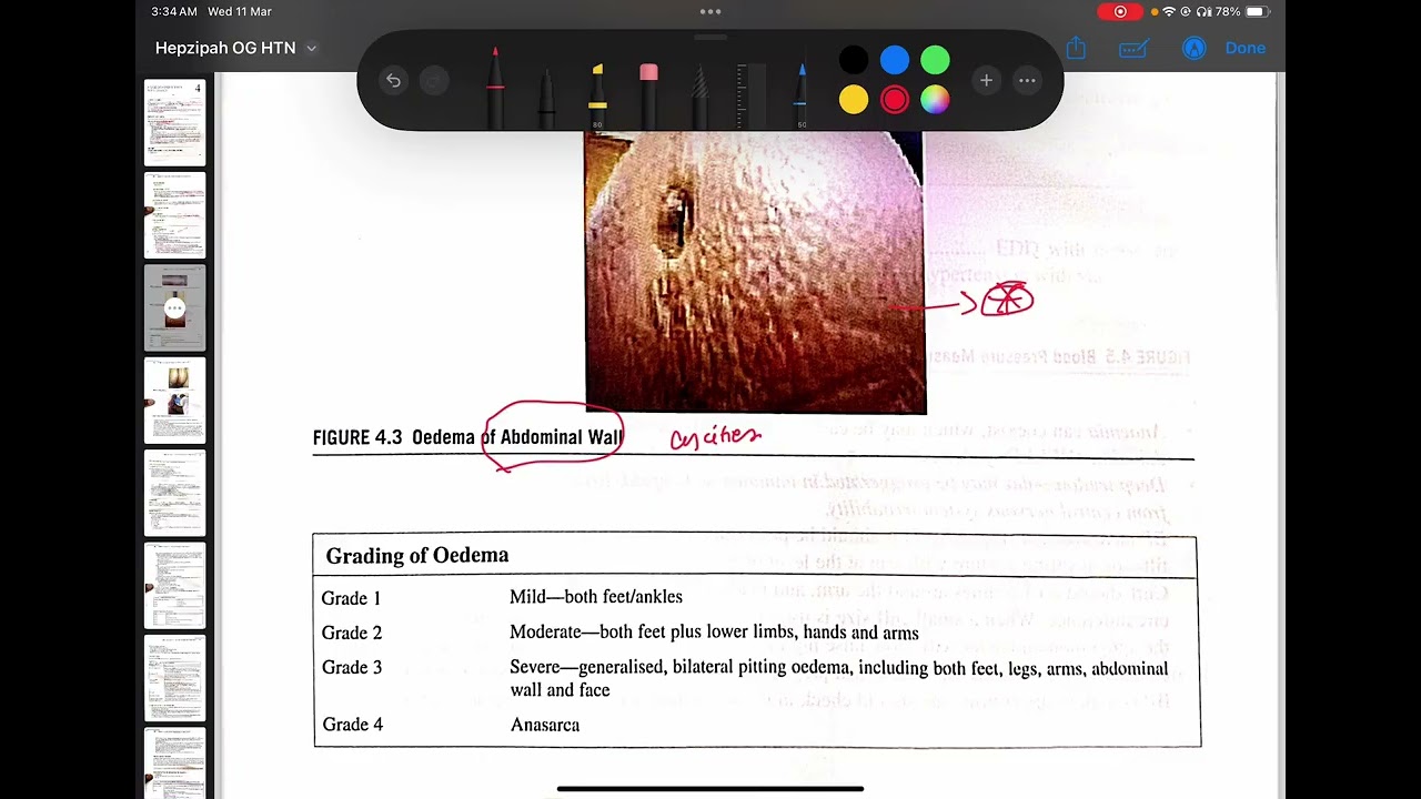 A case of HTN in Pregnancy | Hepzipah |part 1