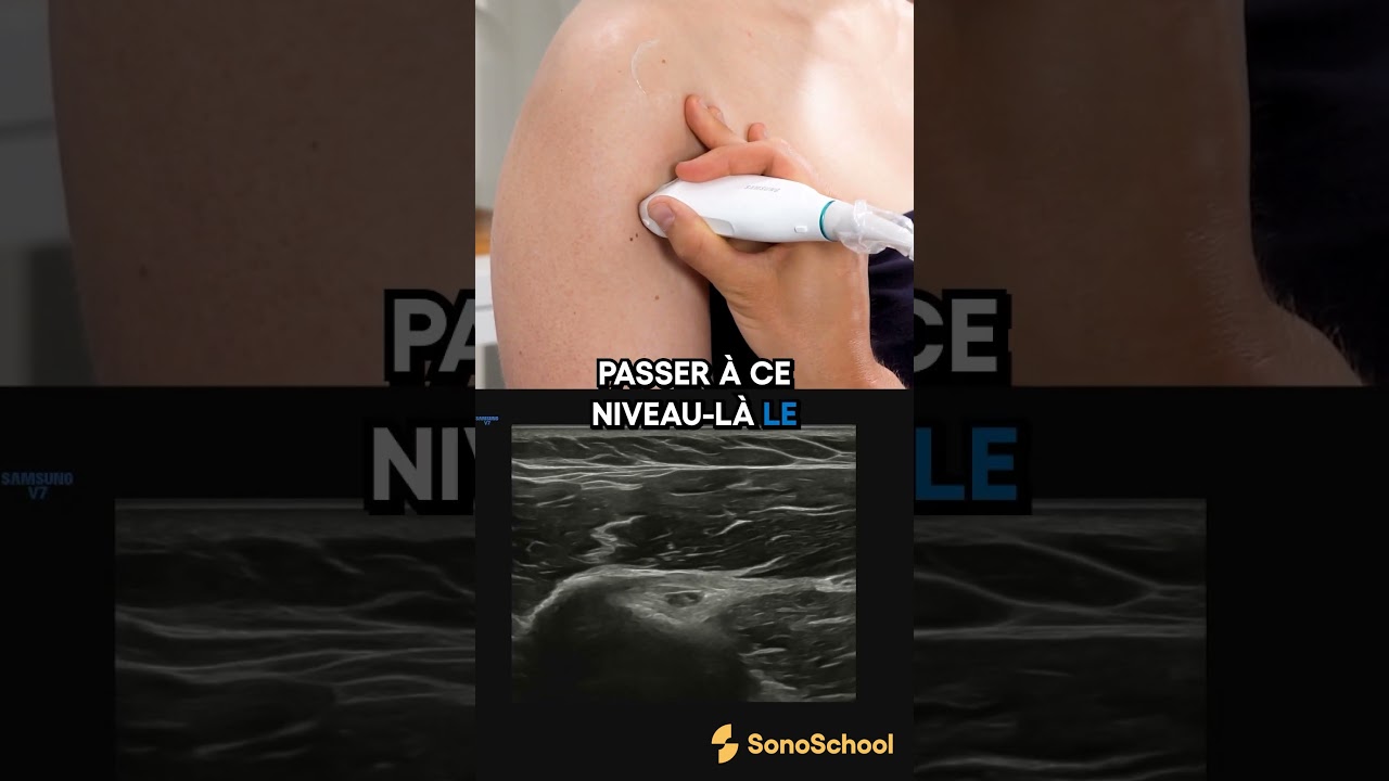 Comment visualiser le tendon du long biceps par le Dr A.Ferenczi - iSonic | SonoSchool