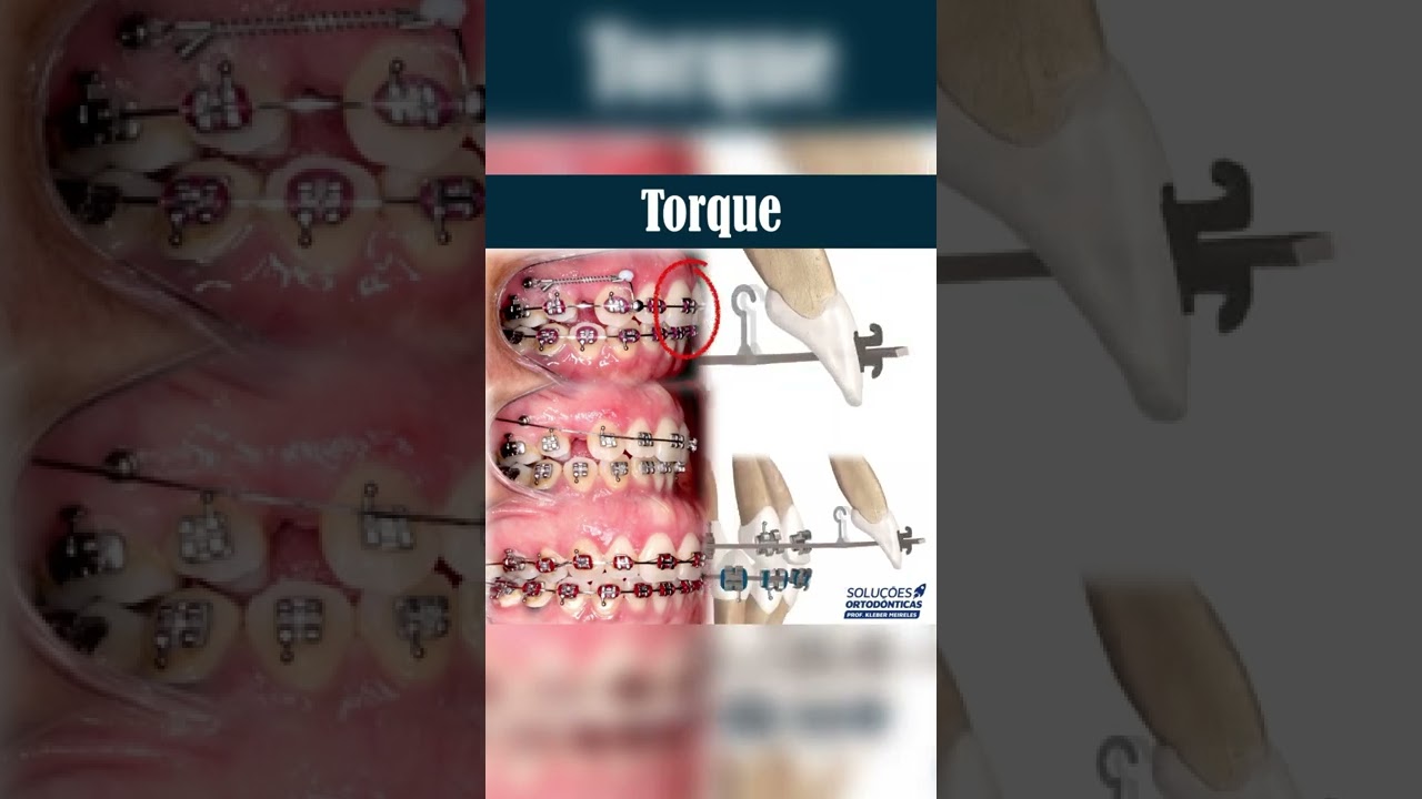 TORQUE - ORTHODONTIC TIPS 