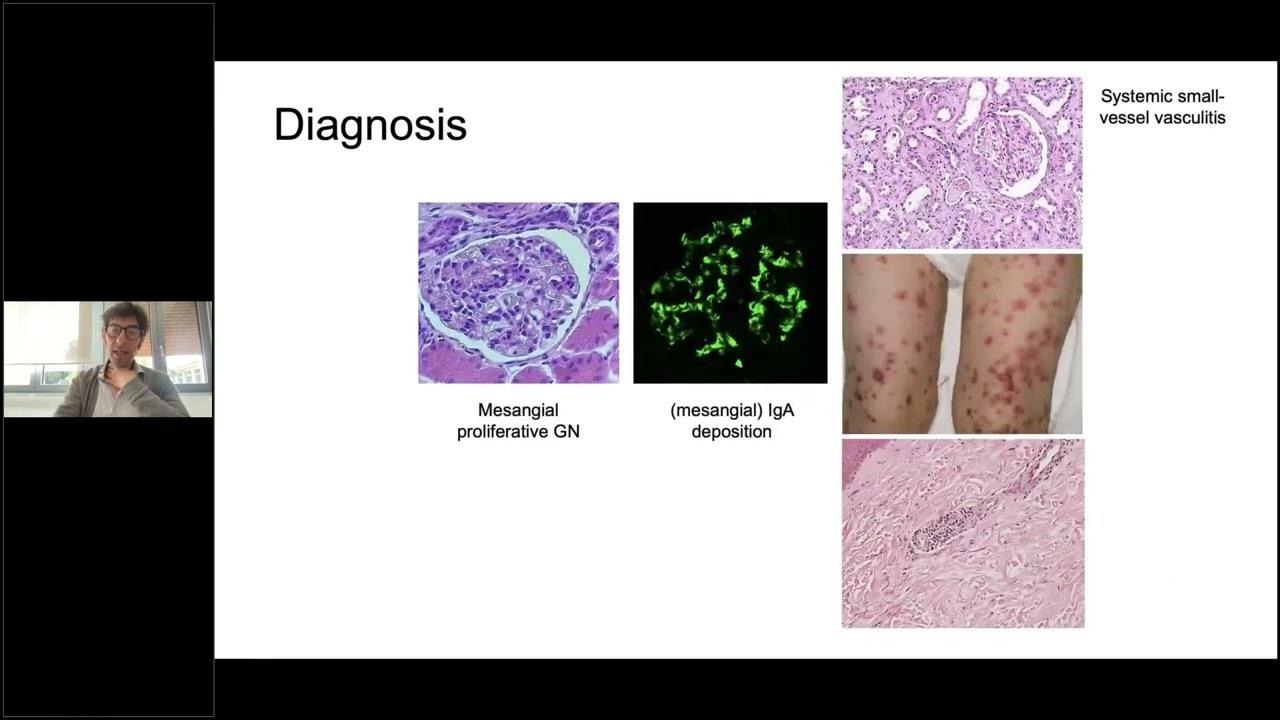 How I manage IgA Vasculitis  | Tuesday Lunch with RITA & EUVAS