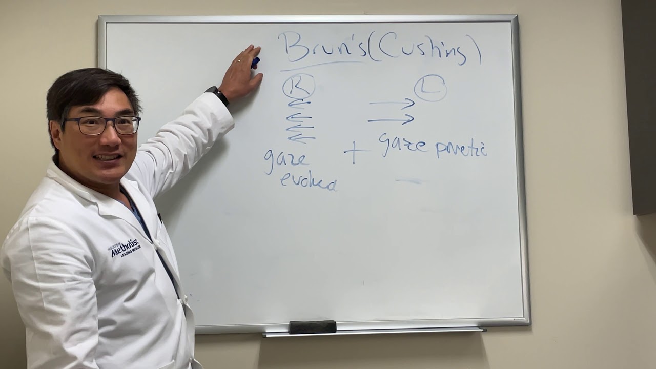 Bruns (Cushing) nystagmus