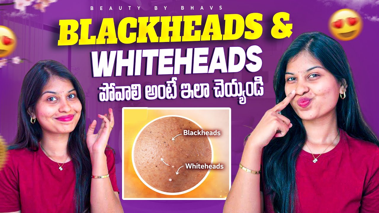 Blackheads & Whiteheads Explained | Causes, Mistakes & Right Treatment in Telugu | Beautybybhavs