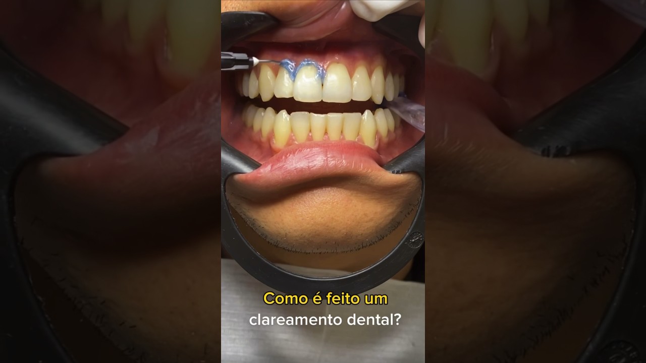 Como &eacute; feito um clareamento dental?🦷 #clareamentodental #dentesbrancos #clareamento