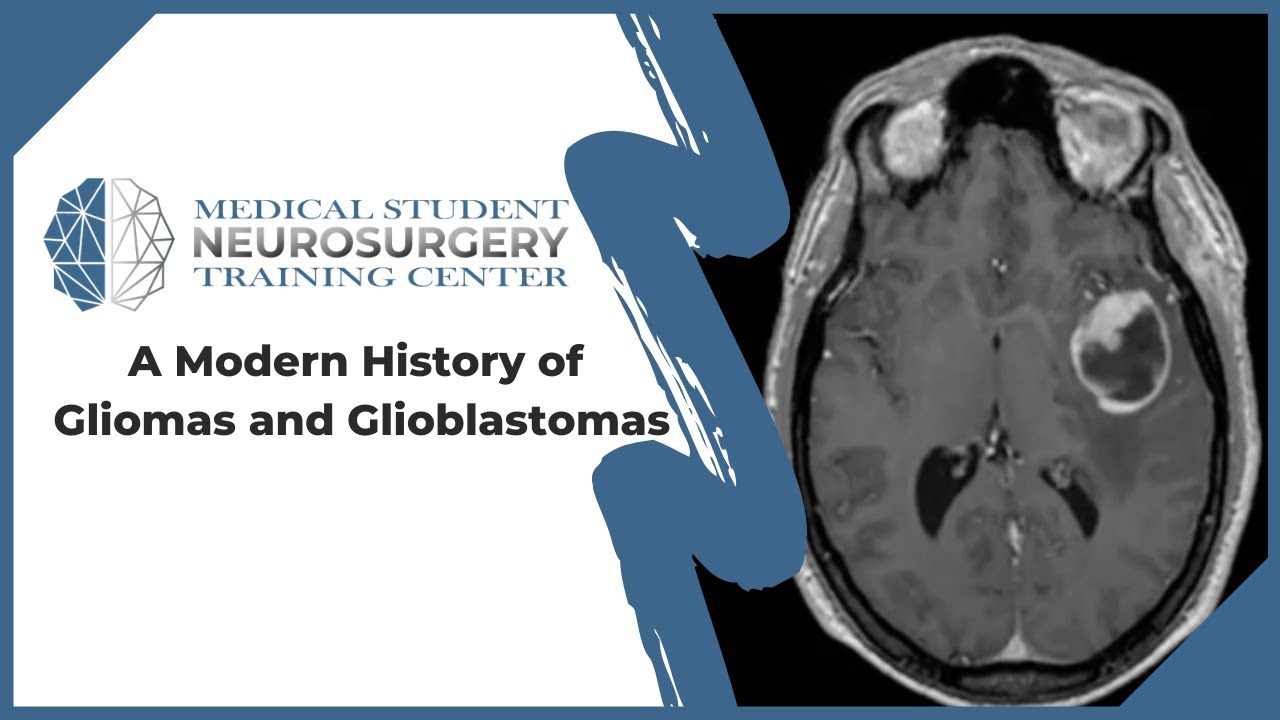 A Modern History of Gliomas and Glioblastomas