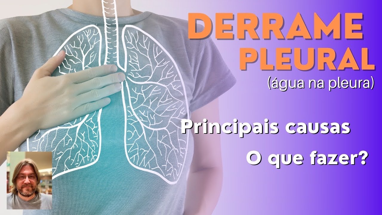 Derrame pleural (&aacute;gua na pleura): saiba quais s&atilde;o as 3 causas mais comuns