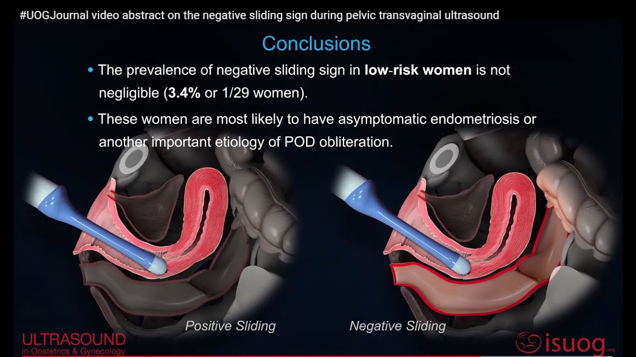 #UOGJournal video abstract on the negative sliding sign during pelvic transvaginal ultrasound