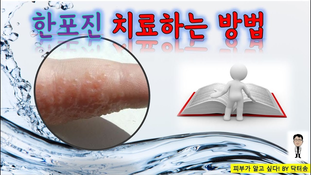 한포진치료하는방법/한포진치료/한포진치료법/한포진원인/한포진제거