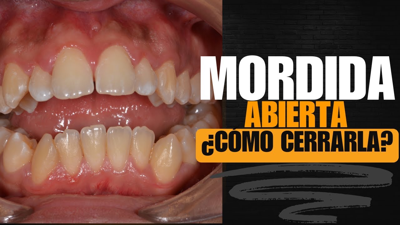 🦷 TRATAMIENTO DE MORDIDA ABIERTA CON TÉCNICA GEAW 💡 Y ABORDAJE FUNCIONAL INTEGRAL 💪👃