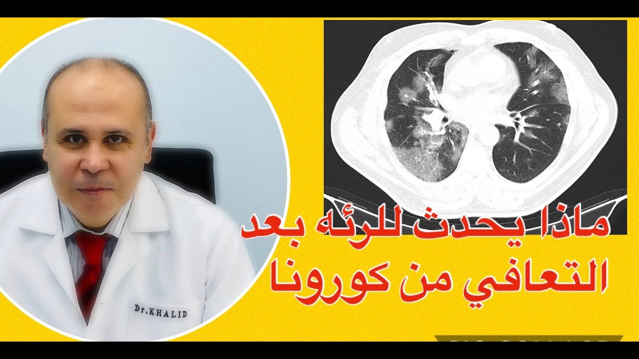 ماذا سيحدث للرئه بعد التعافي من كورونا ..جلطات الرئه وأدويه سيوله الدم