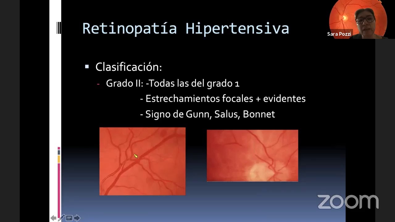 Clase Pre grado- Retinopatia Diabetica e Hipertensiva - Dra Sara Pozzi