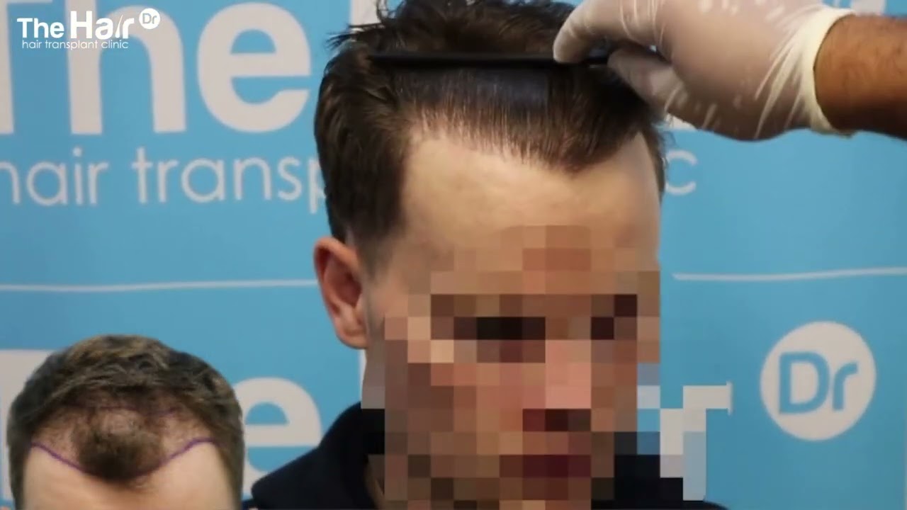 FUE Repair Hair Transplant by Dr Arshad