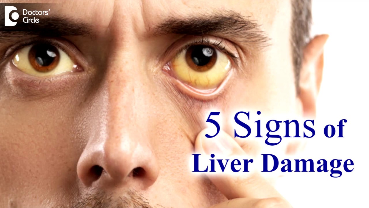Liver disease Symptoms in adults. 5 Signs your liver is damaged - Dr. Ravindra B S | Doctors' Circle