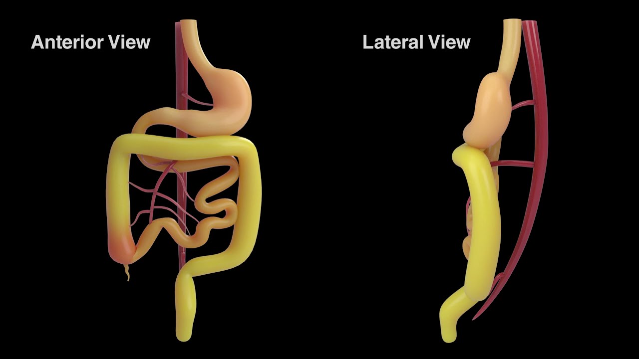 New Revelations in the Pathophysiology and Surgical Management of Congenital Gut Malrotation