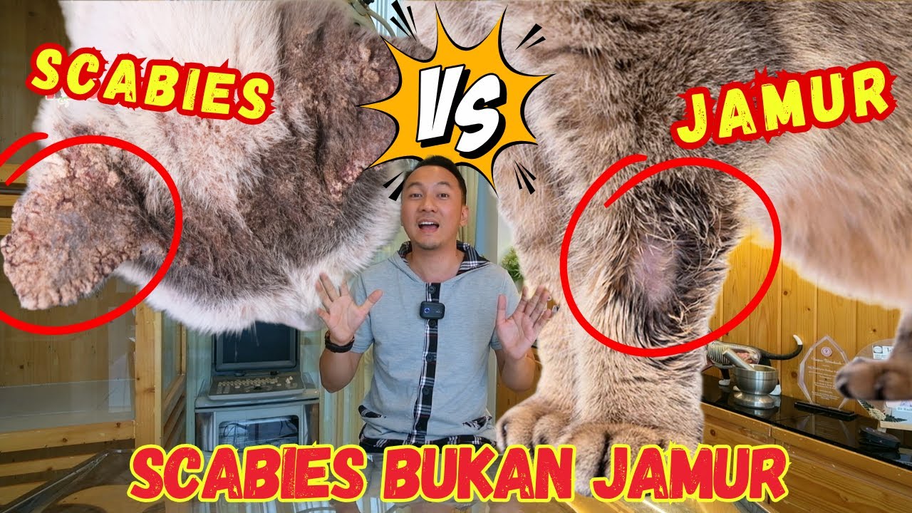 Scabies dan Jamur Itu Beda! Kenali Gejala & Penyebabnya