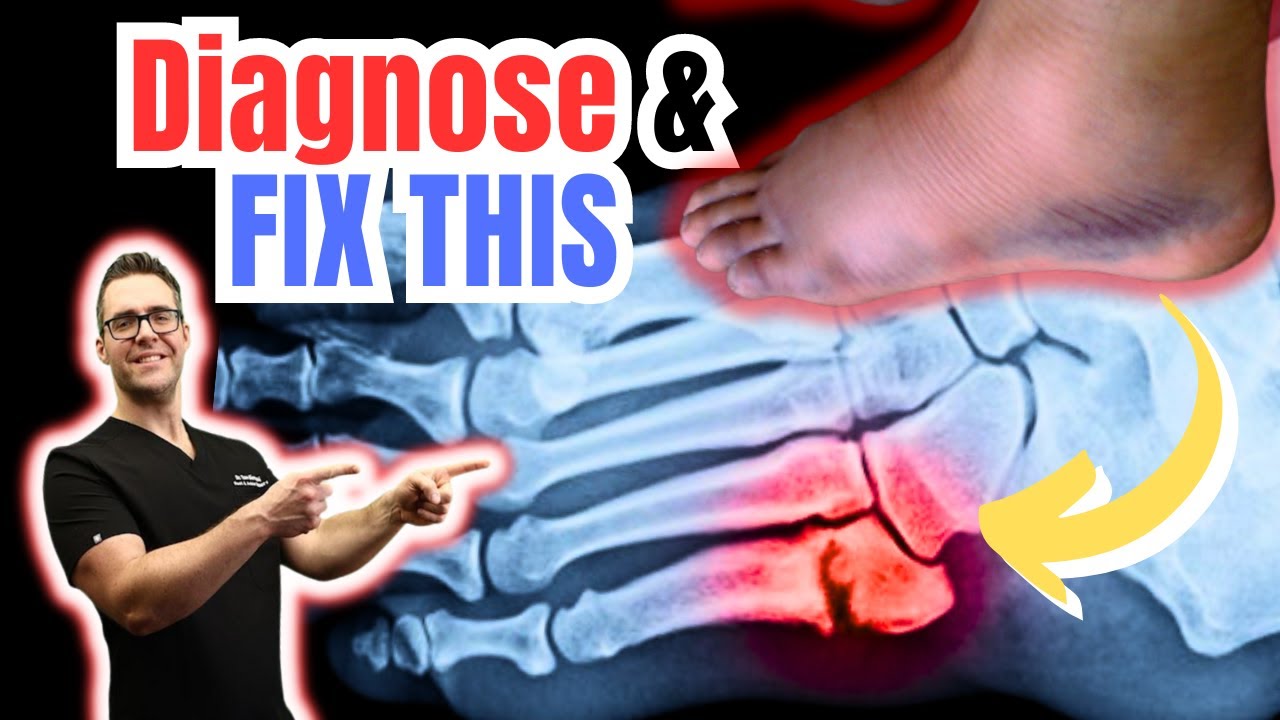 5th Metatarsal & Jones Fracture [FAST Recovery, Treatment & Surgery]