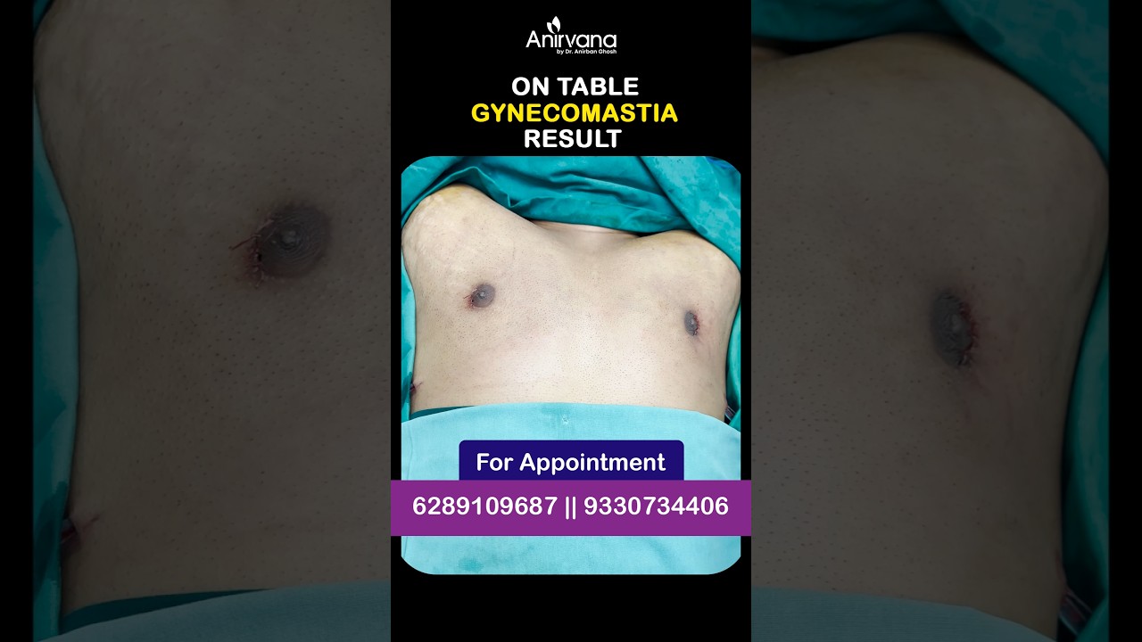 💪 Bodybuilder Gynecomastia Surgery | Just After Operation Result! 😲