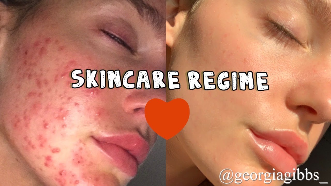 My skincare routine | bye bye acne & irritated skin | Georgia Gibbs unfiltered