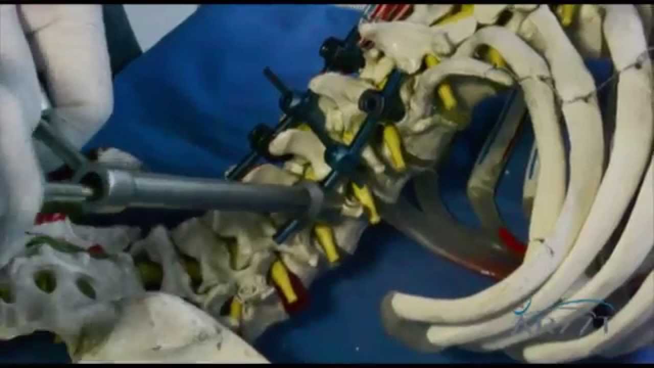 Técnica para Tornillo Lumbar Spalte