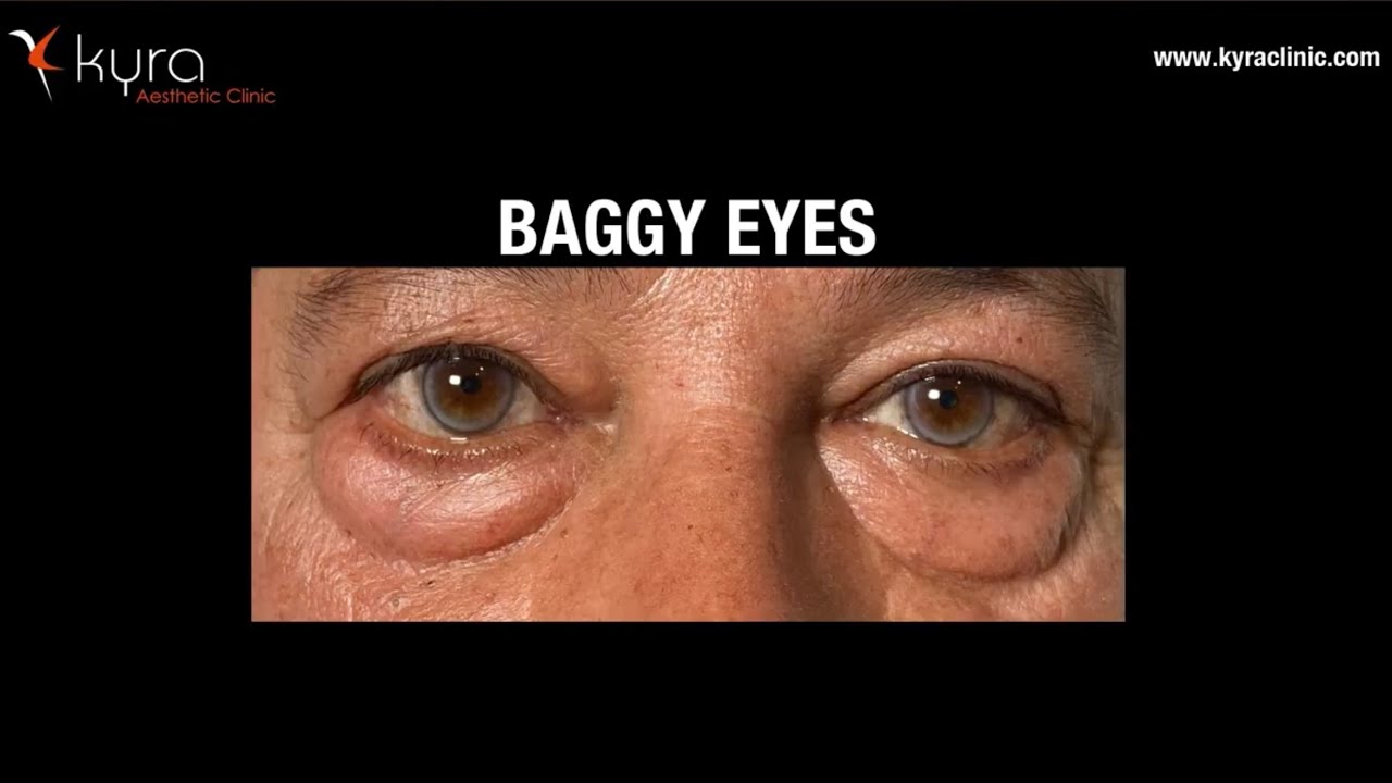 All Facts About Blepharoplasty or Eyelid Surgery - Kyra Clinic Ludhiana