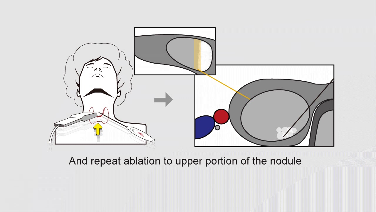 Rf Ablasyon Tiroid