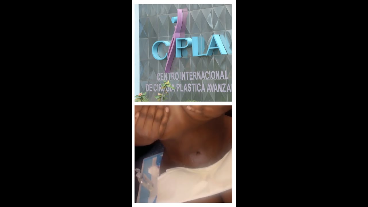 My Round 2 BBL Journey with Dr Marcos Soto in DR!