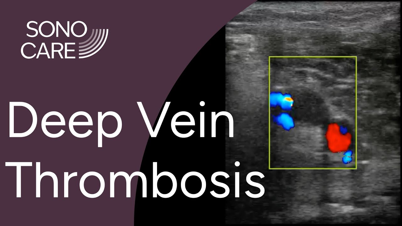 Deep Vein Thrombosis (DVT) Studies
