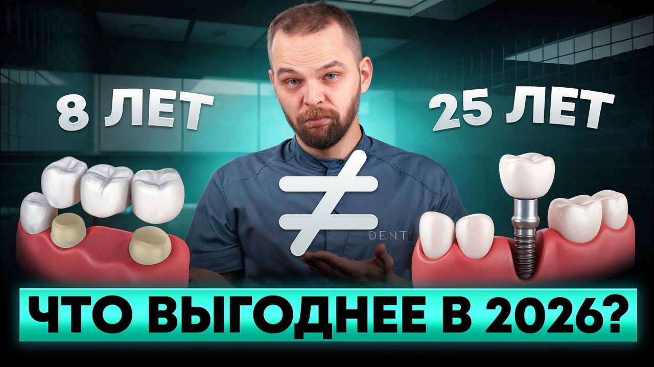 Имплант vs мост: что лучше?