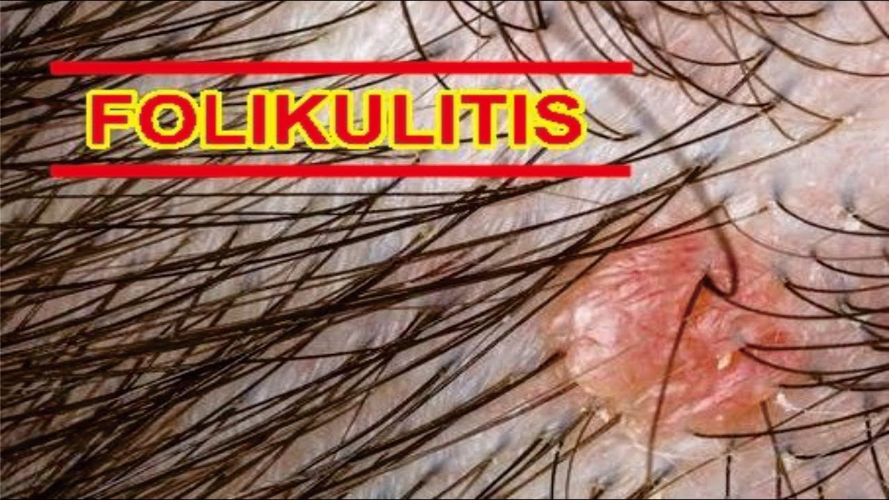 FOLICULLITIS, Definisi, Gejala, Penyebab, Jenis, Pengobatan, Komplikasi dan Pencegahan