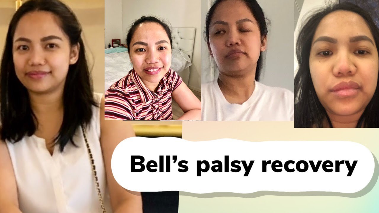 Bell´s palsy and my experience | signs & symptoms | Facial exercises.