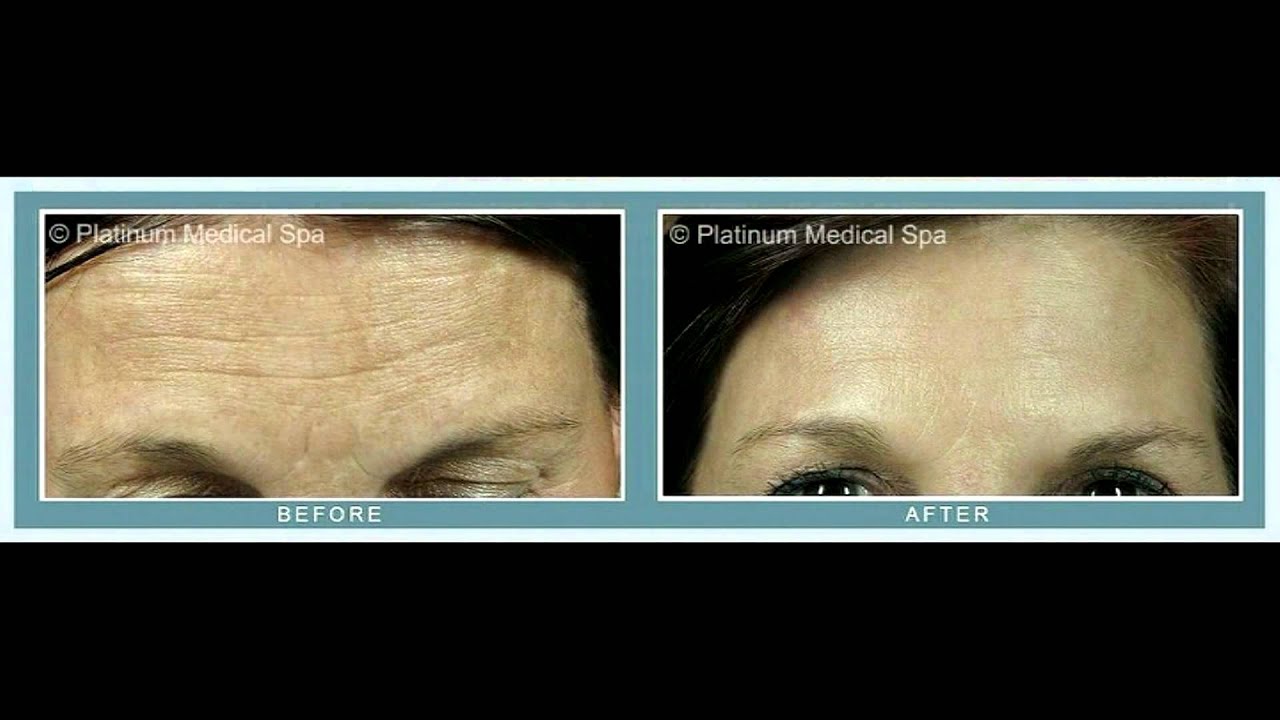 Orange County IPL | Orange County Spa