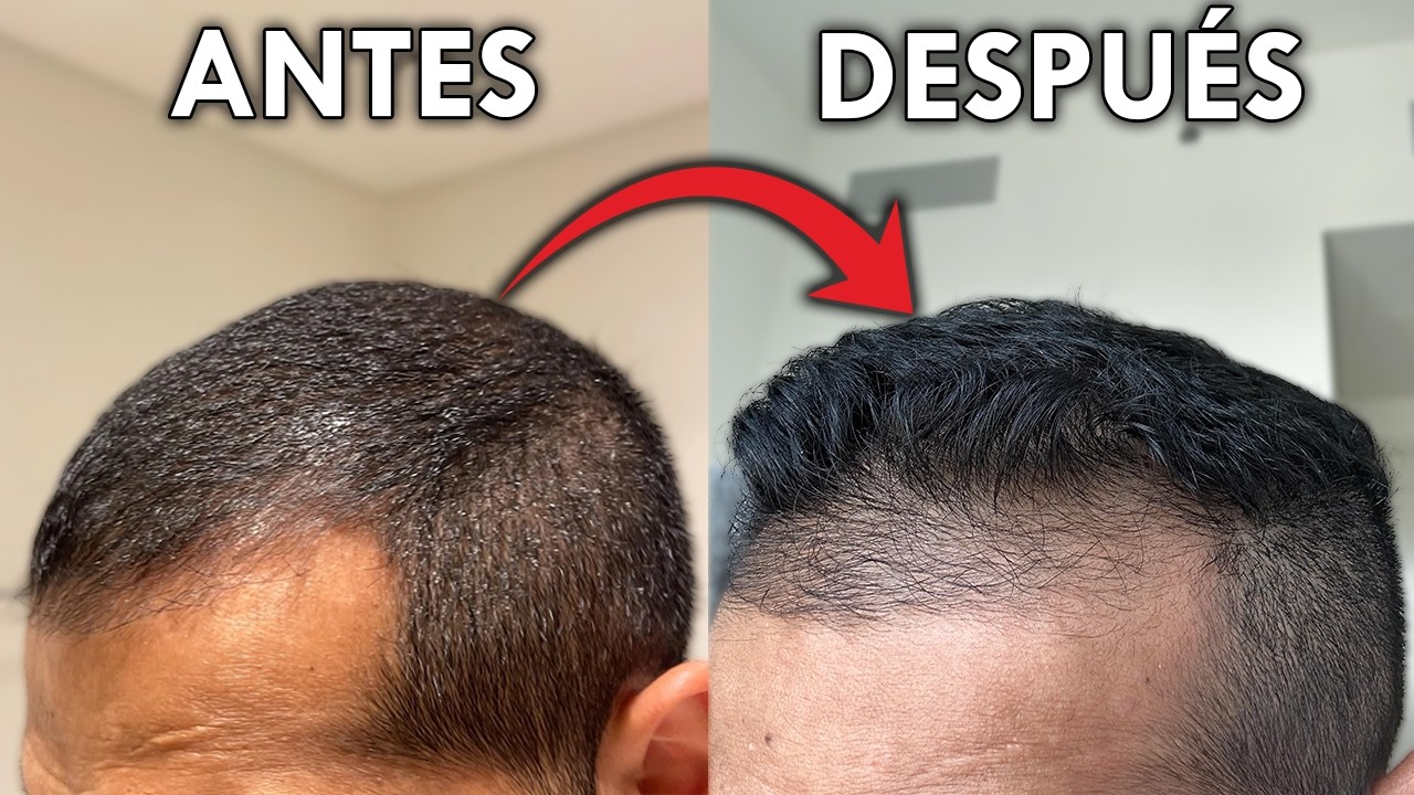 No Es Un Injerto Capilar (Aunque Lo Parece)