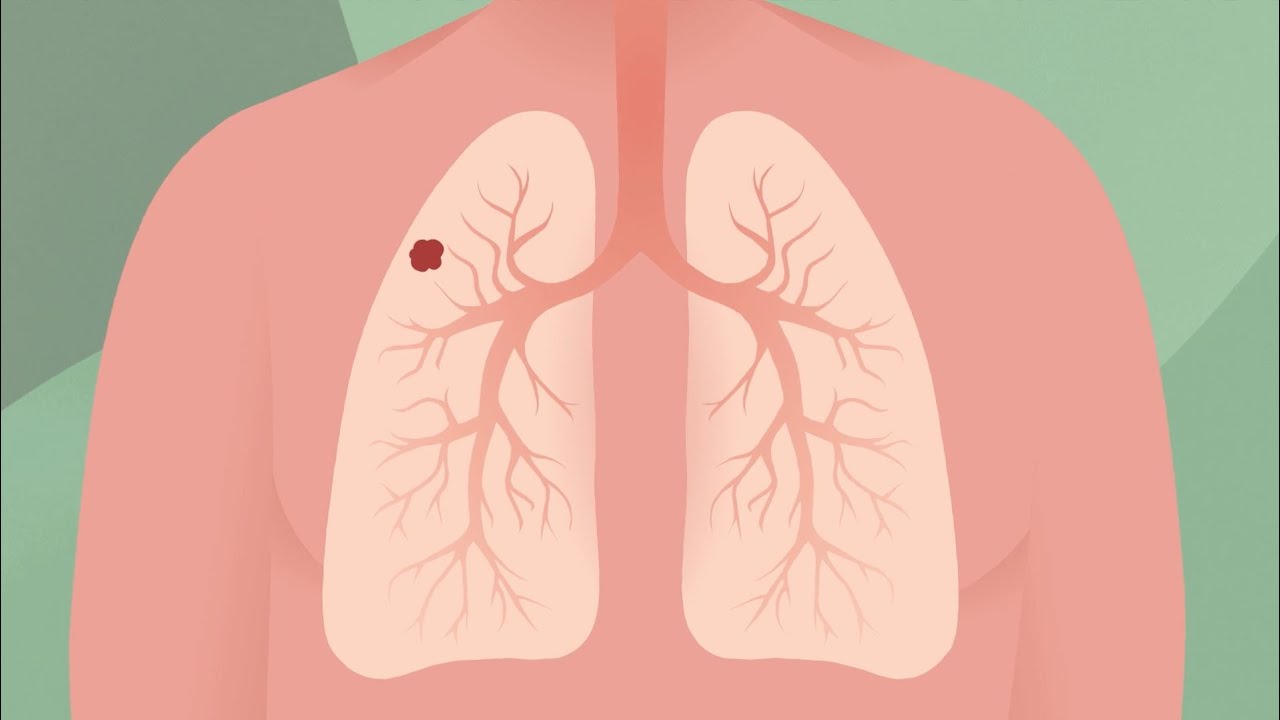 Informations sur le cancer du poumon, soutien et conseils