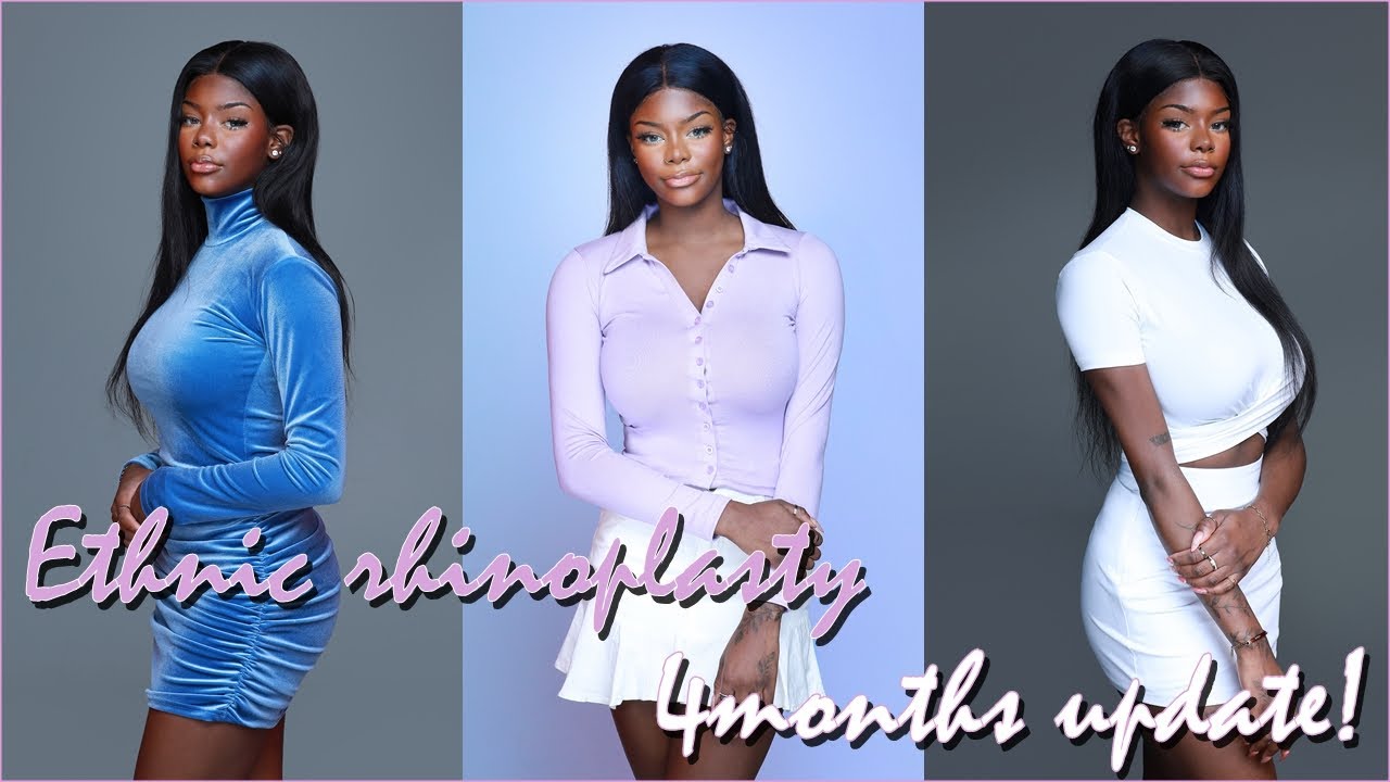 Ethnic rhinoplasty - 4months update photoshoot!