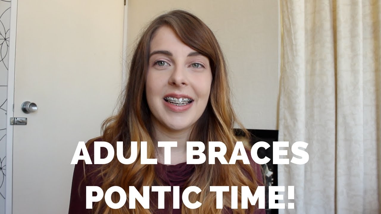 Adult Braces | I got Pontics!