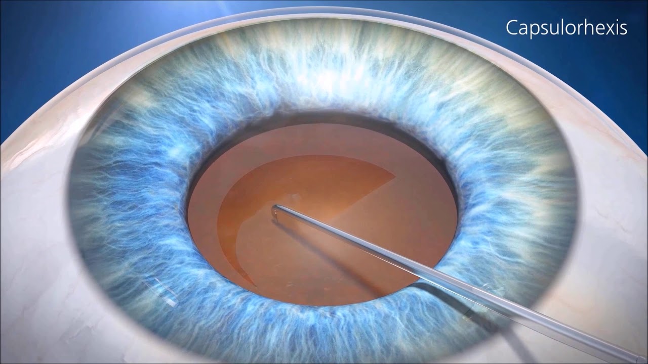Tratamentul Cataractei Video Explicativ