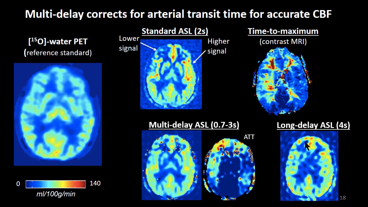 Advanced medical imaging to measure brain blood flow