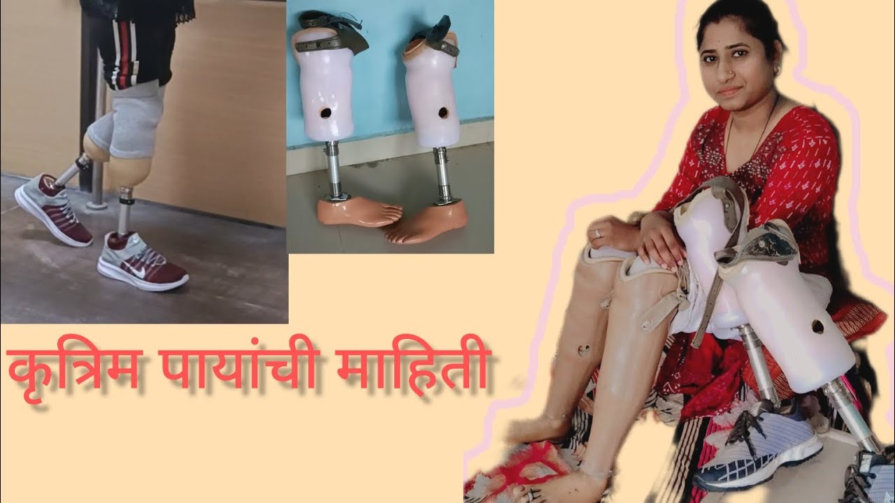 कृत्रिम पाय कोणकोणत्या प्रकारचे असतात या व्हिडिओच्या माध्यमातून माहिती बघणार आहोत