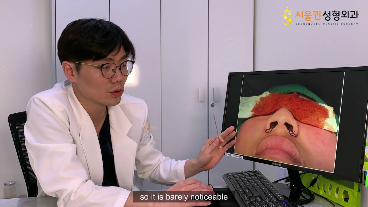 SQPS: What you should know about alarplasty
