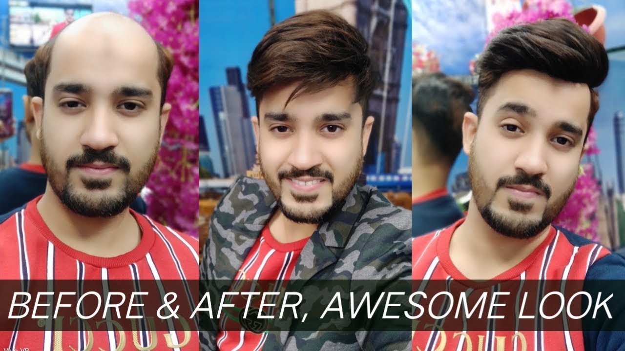 📲 9650914665, after using hair straighten, patch looks dam awesome, by anas sheikh free consulting