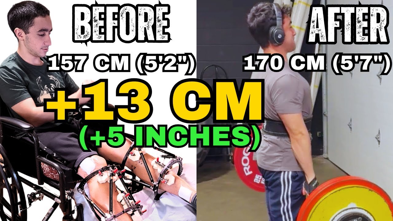 From Wheelchair to Powerlifting: Adam's 5 inch Limb Lengthening Recovery Comeback (157cm → 170cm)