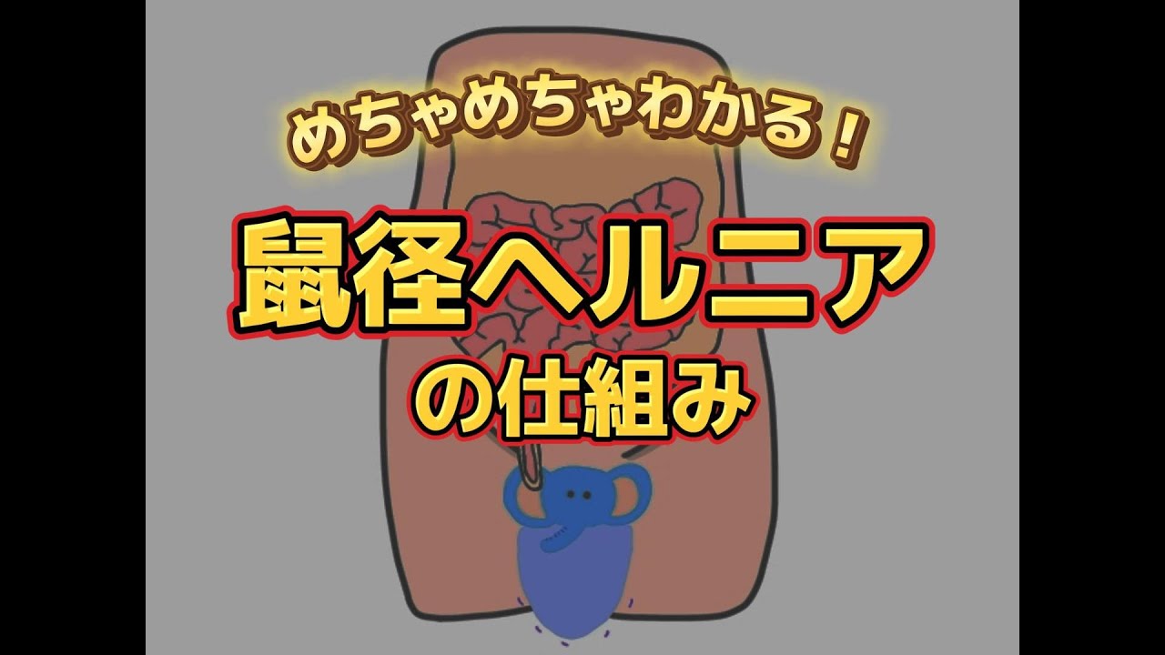 【鼠径ヘルニアの仕組み（脱腸）】アニメーションで解説