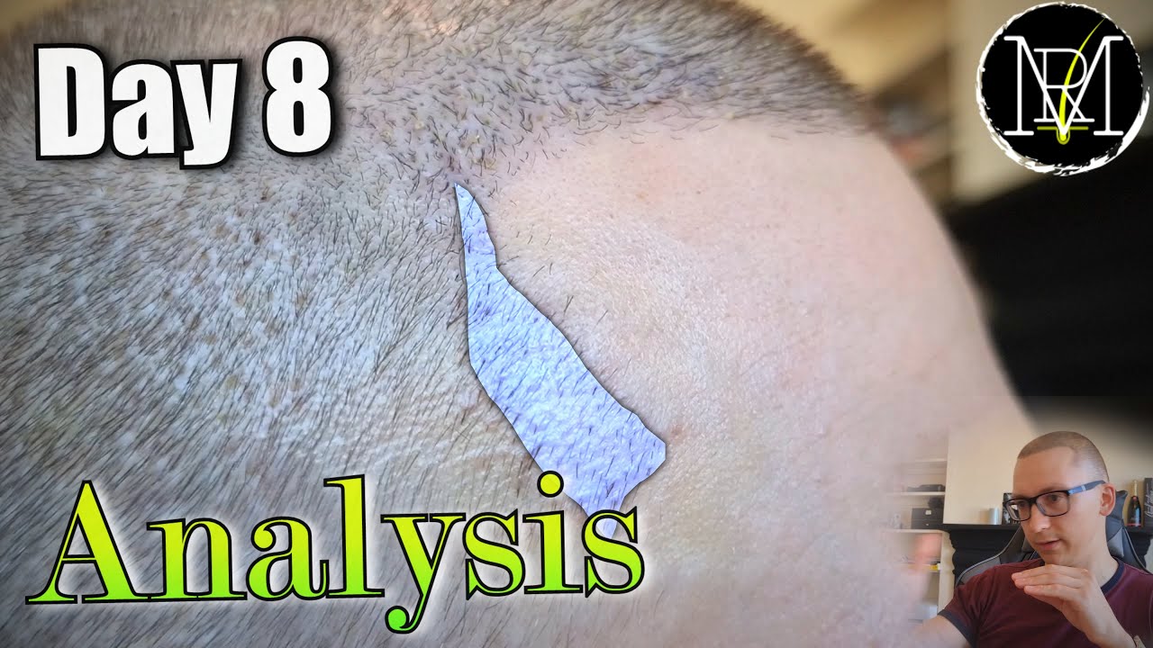 8-й день после пересадки волос методом FUE/DHI. Всё прошло хорошо?!?