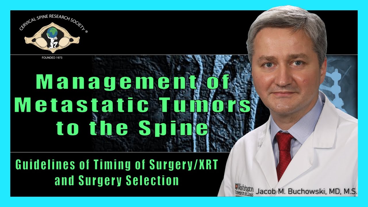 Management of Metastatic Tumors to the Spine